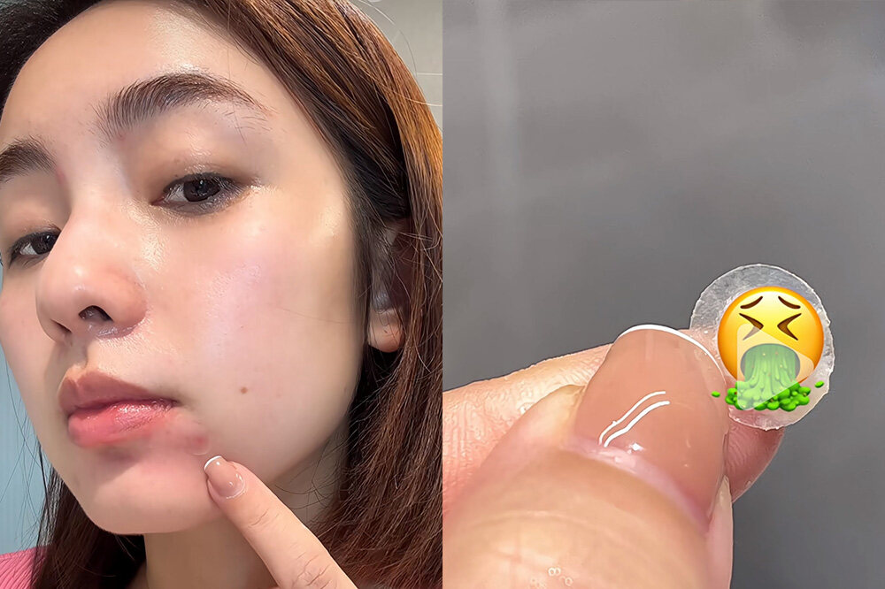 一文認清哪些暗瘡可以擠｜必學正確擠暗瘡方法！擠錯膿疱隨時引發細菌感染🦠