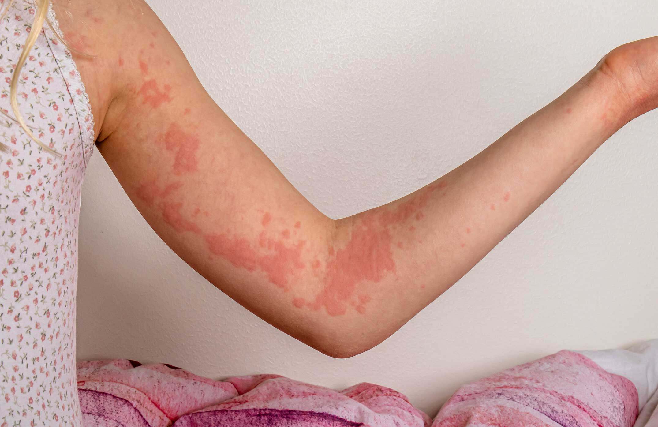 皮膚過敏5大種類｜一文了解濕疹、蕁麻疹、紅疹的症狀 醫生教你急救護理方法