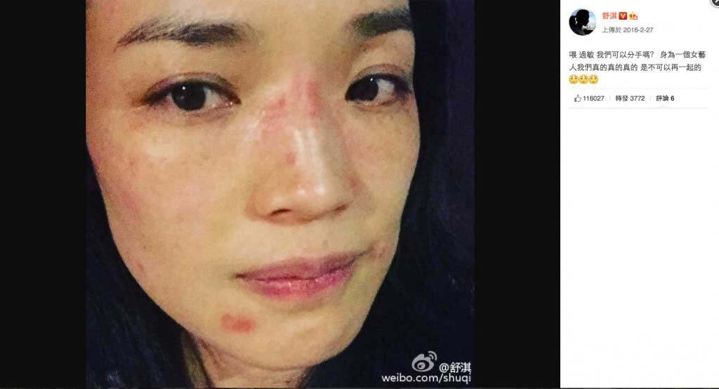 舒淇脫離濾鏡驚現魚尾紋引熱議|因嚴重濕疹暫別演藝圈 5招改善敏感急救爛臉 舒淇脫離濾鏡驚現魚尾紋引熱議|因嚴重濕疹暫別演藝圈 5招改善敏感急救爛臉