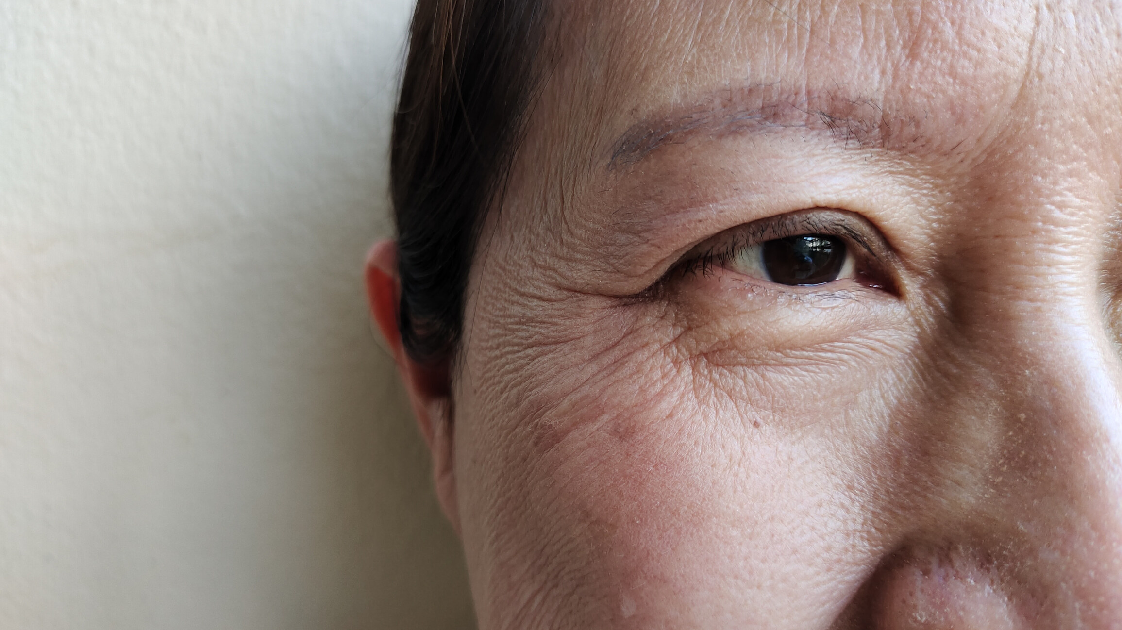 老人斑是甚麼？皮膚科專科醫生拆解成因、消除及預防方法