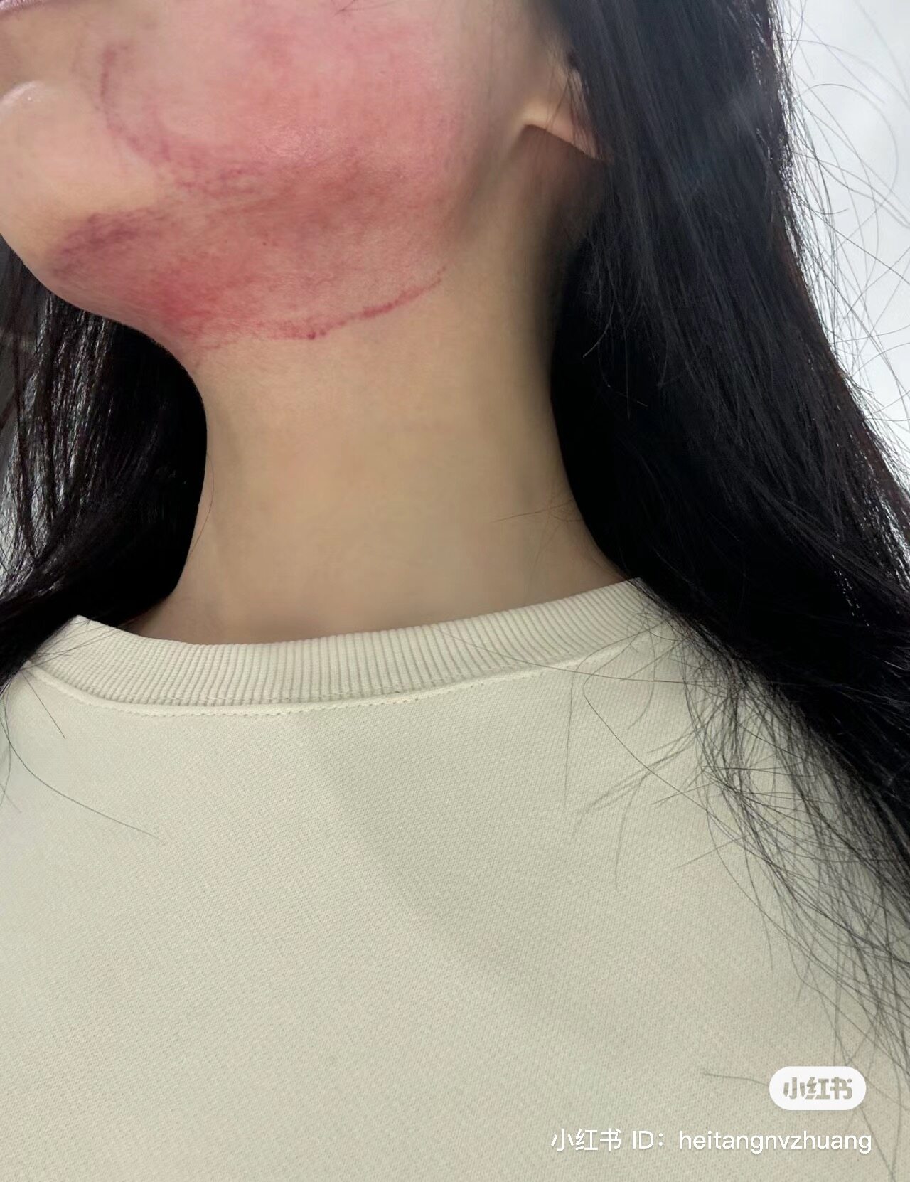 Kim Kardashian 同款瘦面療程！熱潮由歐美直捲韓國｜ 大熱Do臉神器Inmode：減脂消滅雙下巴