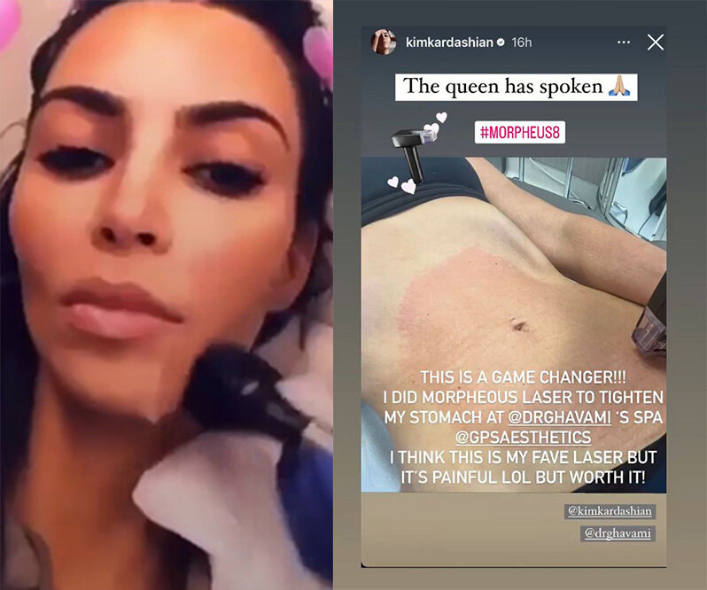 Kim Kardashian 同款瘦面療程！熱潮由歐美直捲韓國｜ 大熱Do臉神器Inmode：減脂消滅雙下巴