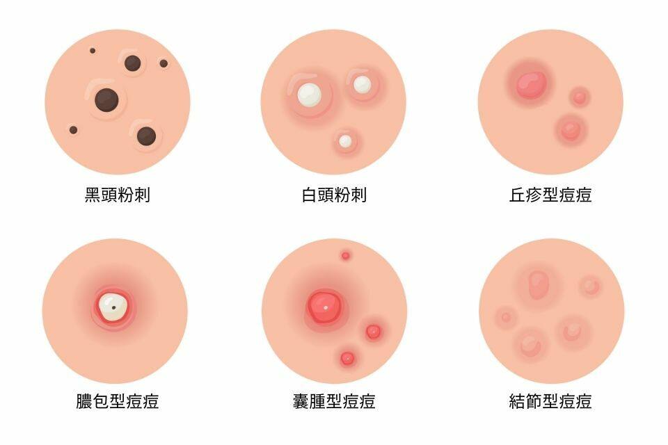 一文認清哪些暗瘡可以擠｜必學正確擠暗瘡方法！擠錯膿疱隨時引發細菌感染🦠