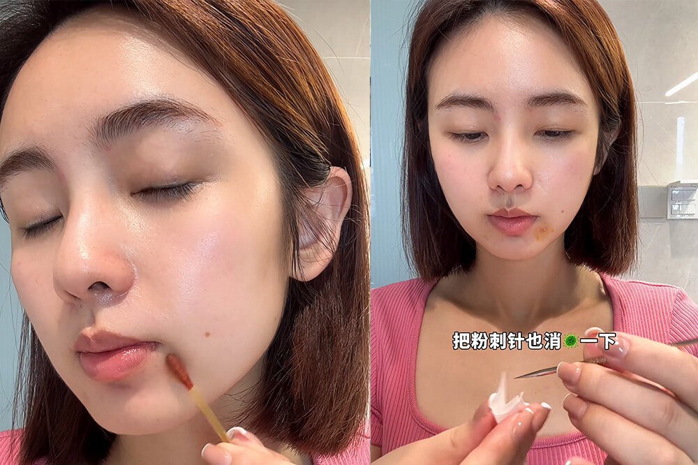 一文認清哪些暗瘡可以擠｜必學正確擠暗瘡方法！擠錯膿疱隨時引發細菌感染🦠