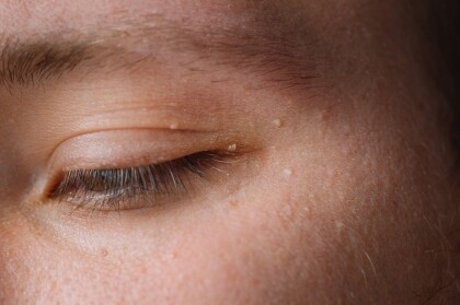 圍繞眼周的油脂粒怎樣解決？眼皮、眼底出油脂粒成因及解決方法，原來塗眼霜習慣也大有影響