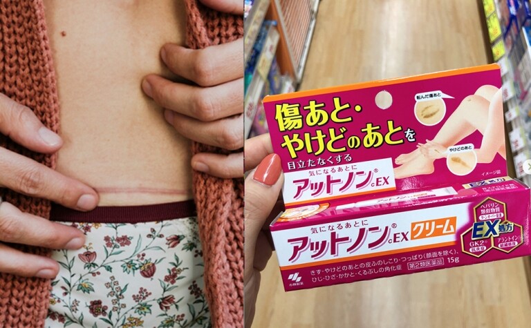 除疤膏推薦9款｜去印不留疤要這樣做！必學5大方法預防疤痕瘀傷變深
