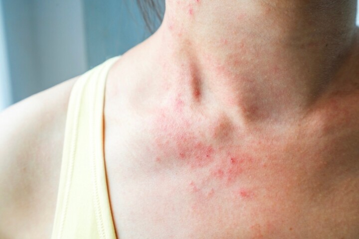 皮膚紅疹起粒粒很痕癢怎麼辦？急救方法由醫生教路，不一定要用類固醇！