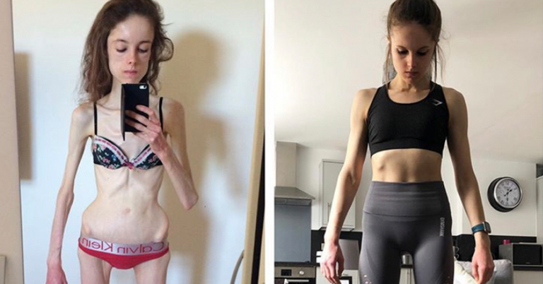 【真人真事】厭食症折磨10年曾誤診為精神病 英女生Hannah：現在重新活過來