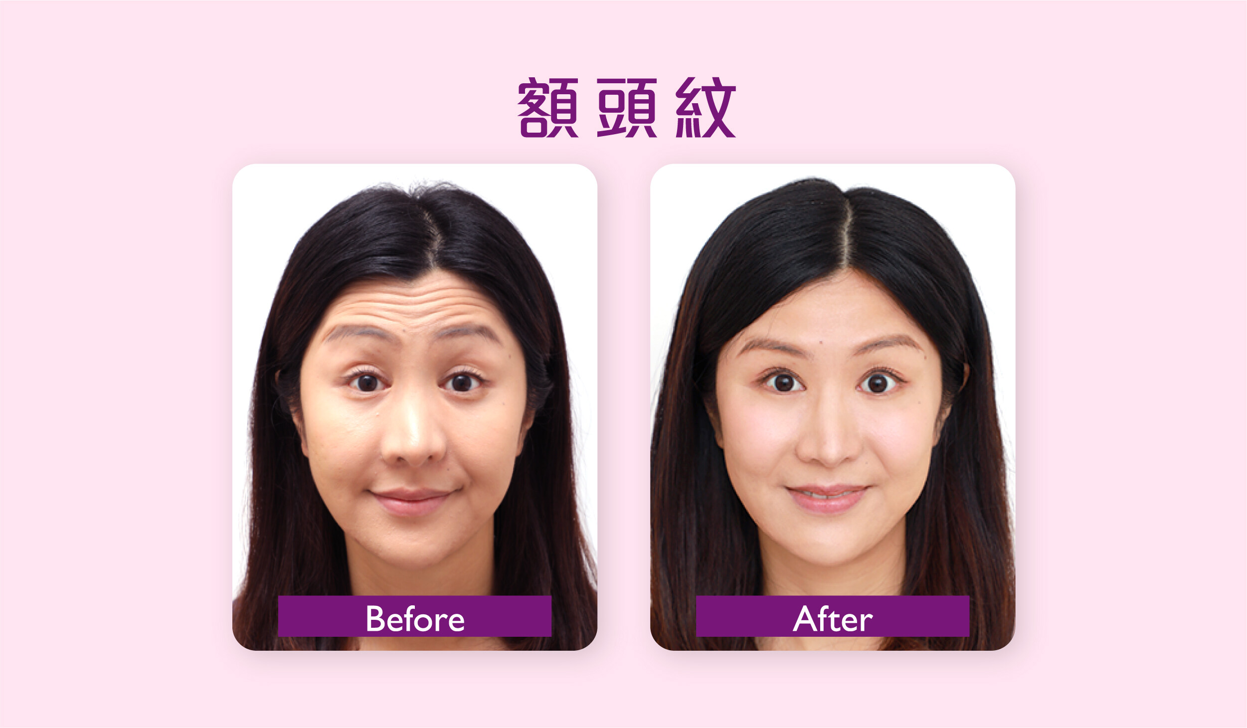 香港打Botox邊間好？我適合Botox去皺瘦面嗎？一文了解Botox價錢、功效及風險