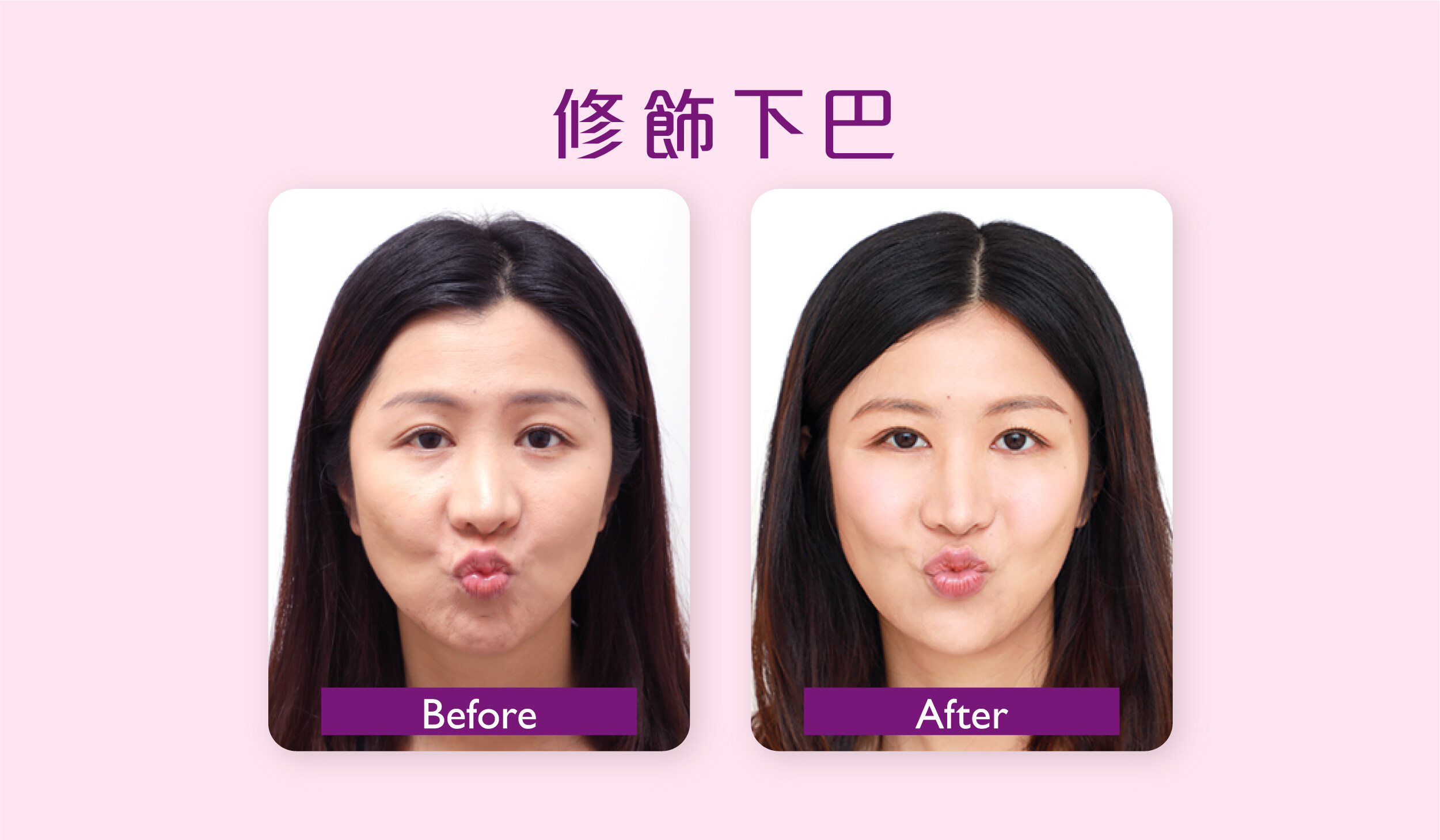 香港打Botox邊間好？我適合Botox去皺瘦面嗎？一文了解Botox價錢、功效及風險