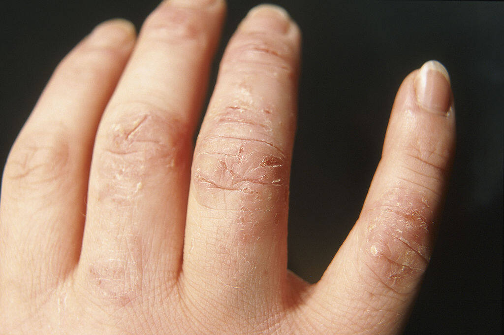 主婦手與濕疹分別在哪裏? 主婦手與濕疹分別在哪裏?