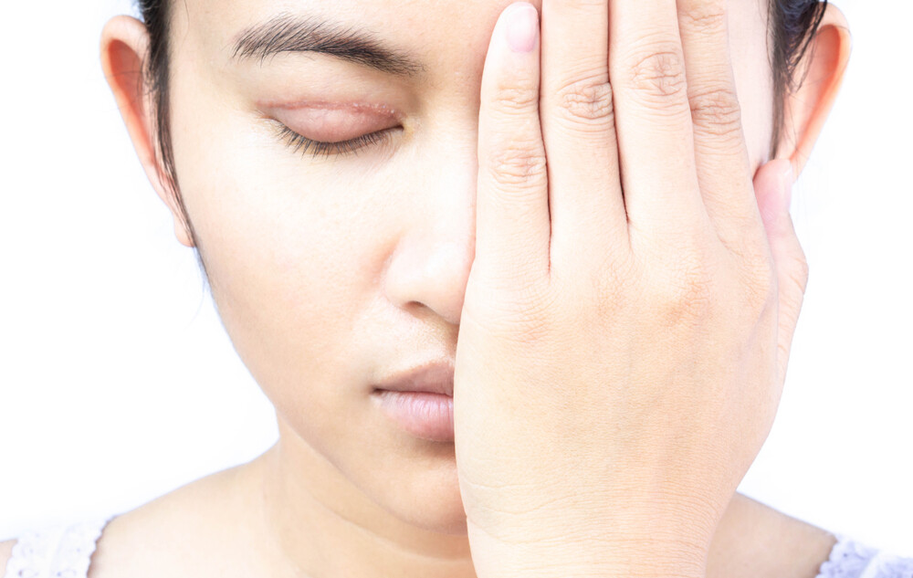割雙眼皮術後最重要是戒口和禁煙酒。