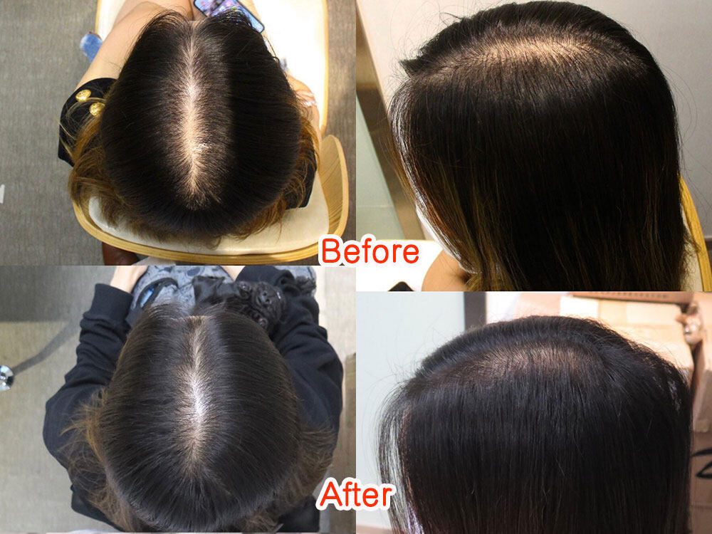 這是友人做過30次療程的效果，頭頂的髮量明顯濃密了許多！