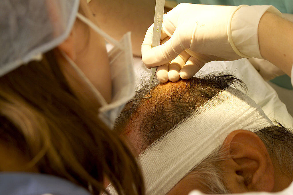 植髮方法 3.DHI® 植髮手術