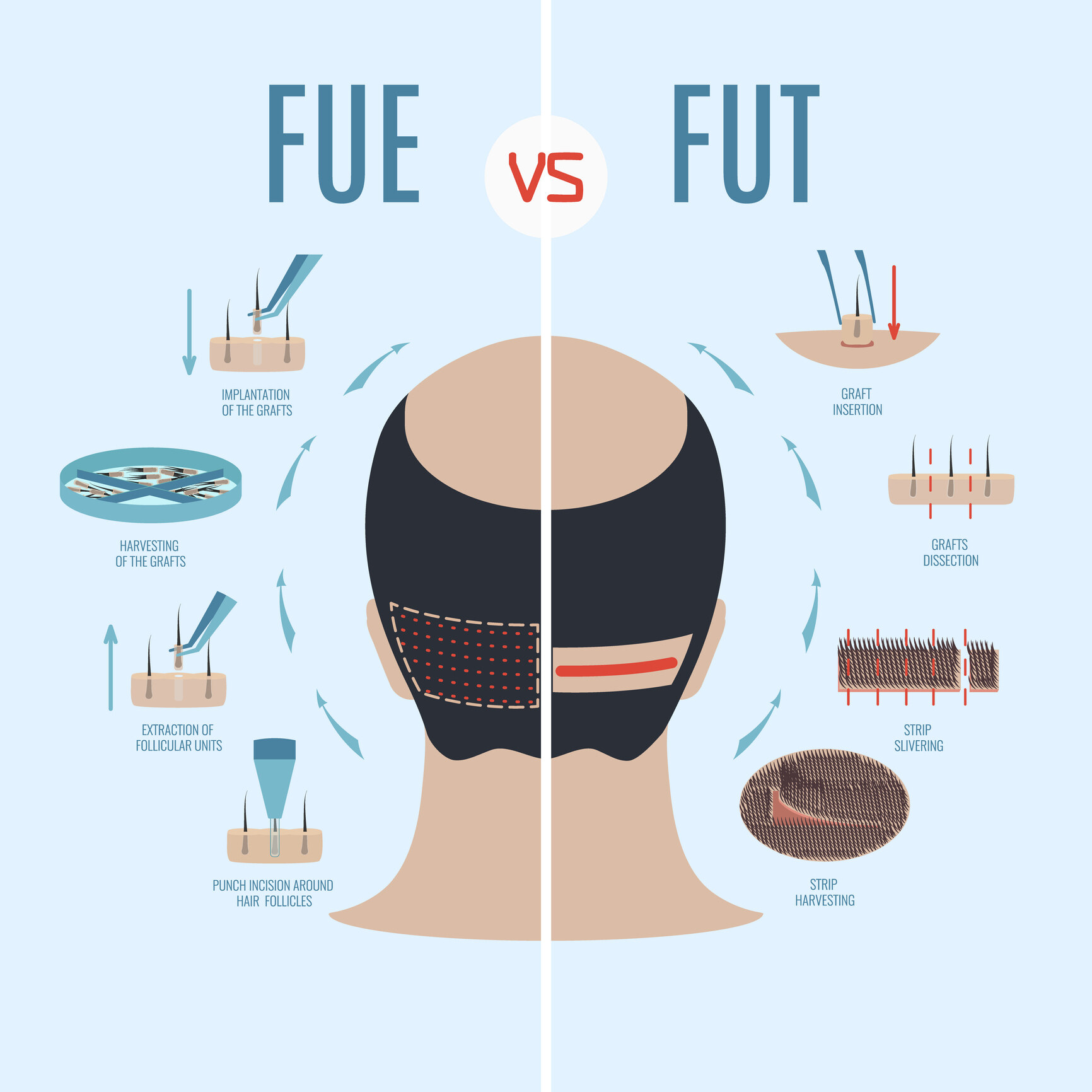 以花費的時間而言， FUE（鑽毛囊）會比 FUT（取頭皮）更精密，需要更長的時間，因此 FUE 會比 FUT 收費更貴。﻿