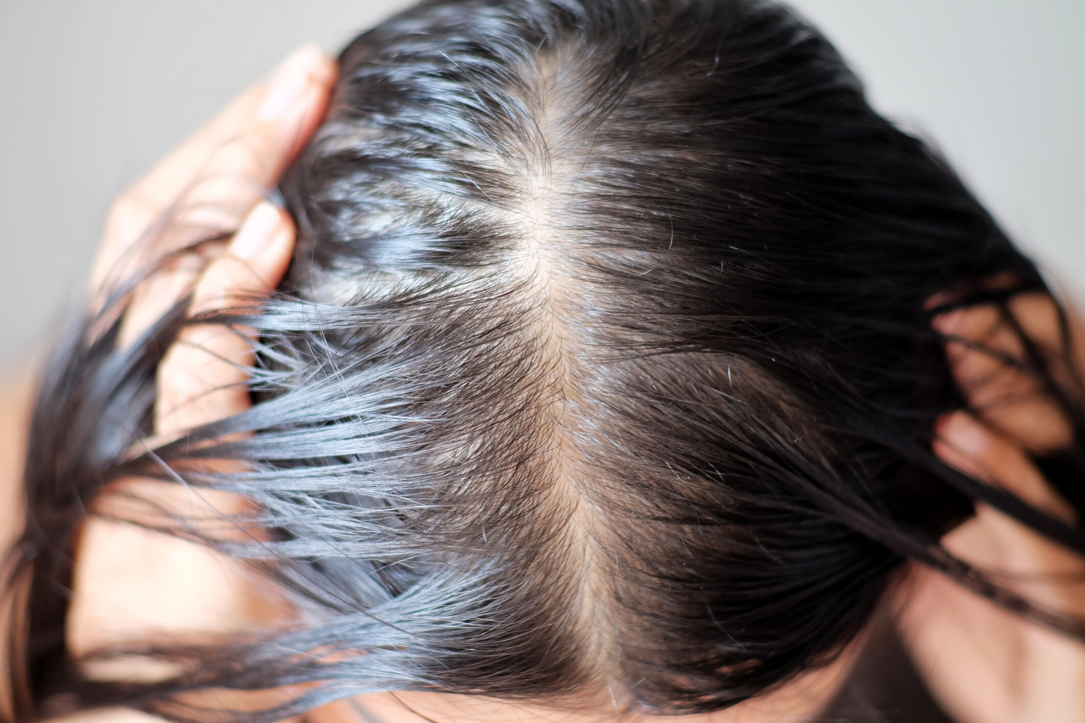 植髮前都要有健康的生髮區和移植區，如有頭瘡都要先處理