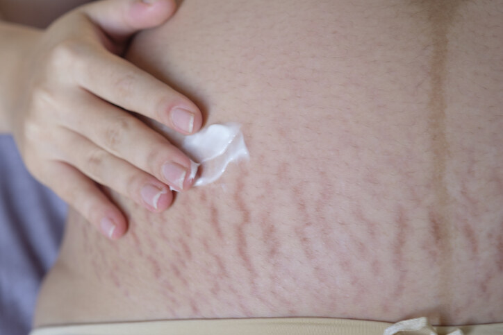 消除妊娠紋及預防方法
