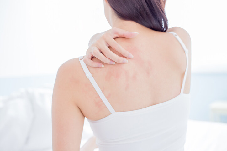 皮膚痕癢原因是甚麼？