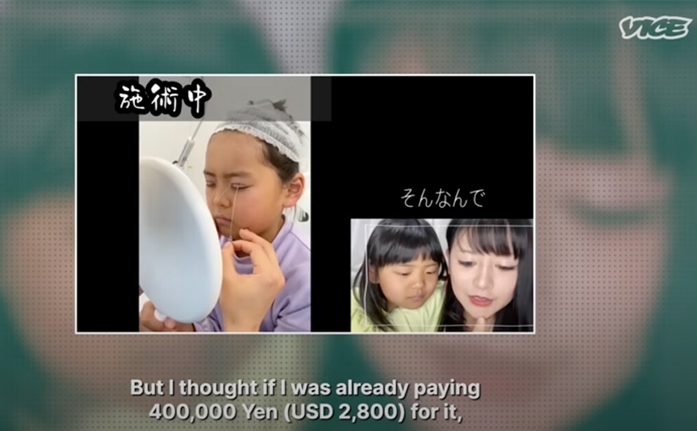日本整容年輕化？9歲女孩受媽媽勸誘割雙眼皮｜全球美容手術量日本排
