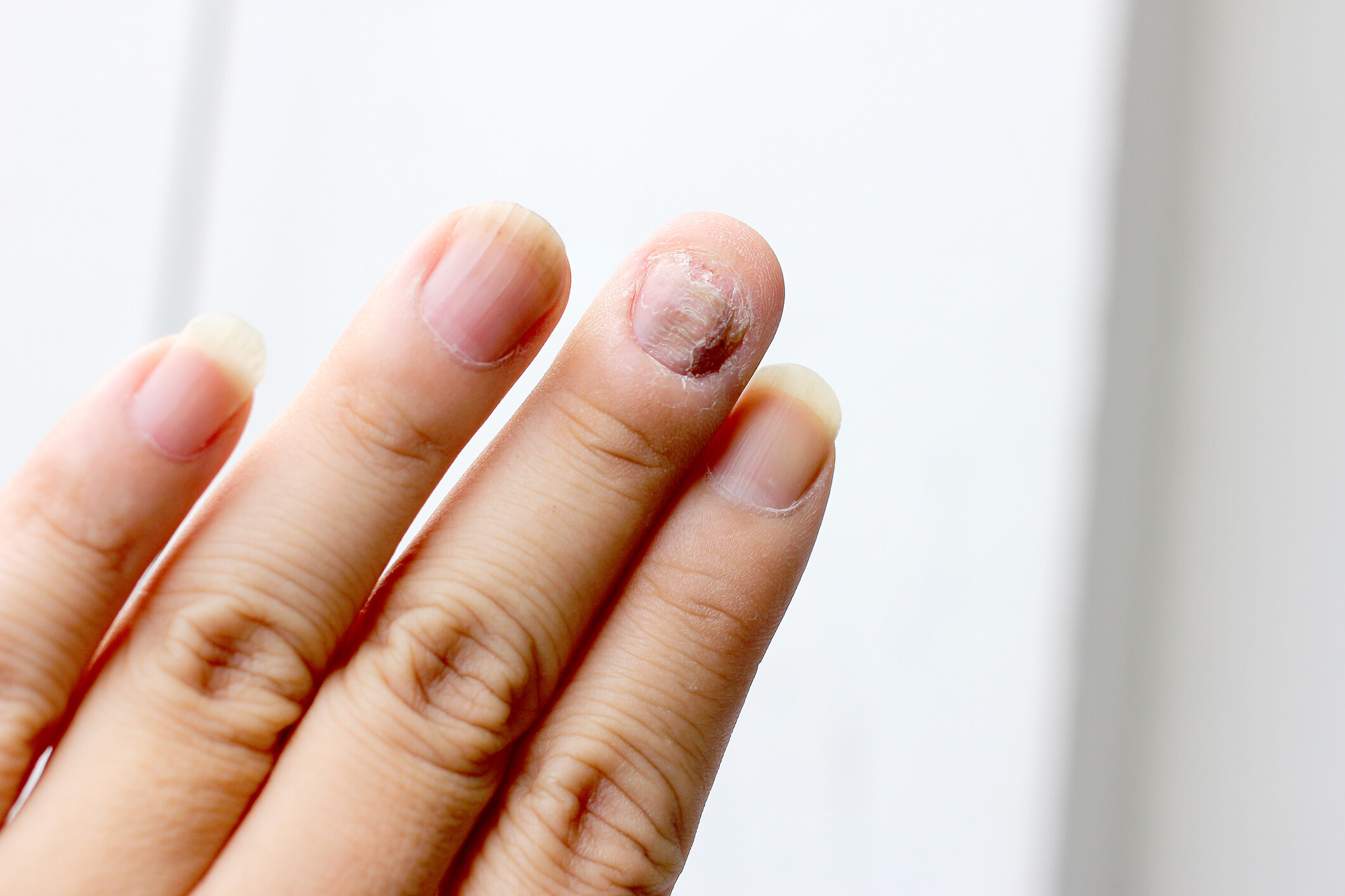 灰指甲初期症状有哪些？很难治吗？ - 哔哩哔哩