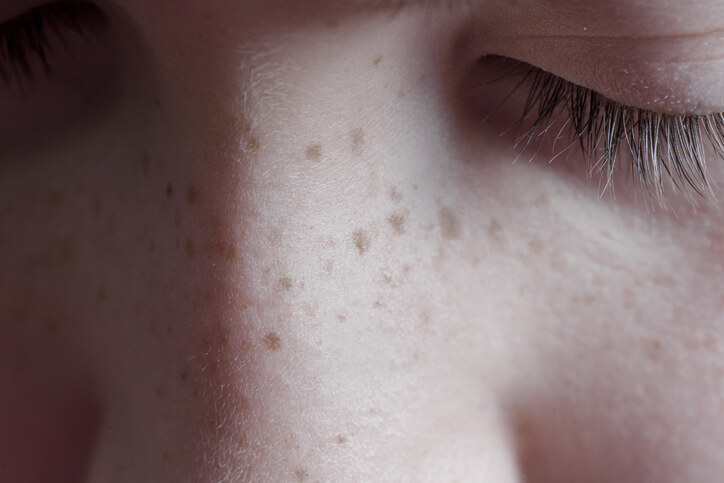 另一個最常見的皮膚初老症狀，就是皮膚開始出現啡色斑點，而且不只出
