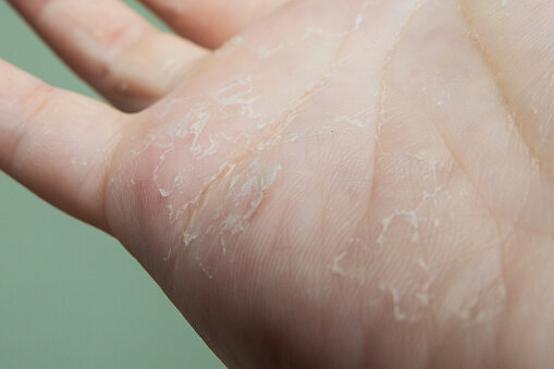 手指手掌甩皮敏感主婦手發作？藥劑師推薦「濕敷療法」20分鐘急救脫皮問