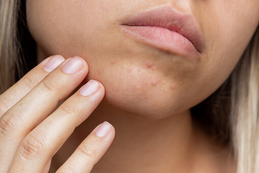 下巴生暗瘡的6大原因：女性宮寒也有關係｜陳敏之一個方法對付下巴痘