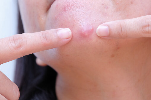 下巴生暗瘡的6大原因：女性宮寒也有關係｜陳敏之一個方法對付下巴痘