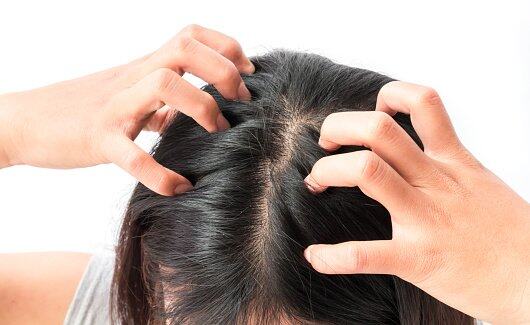 改善脫髮方法 3.正確對待頭皮