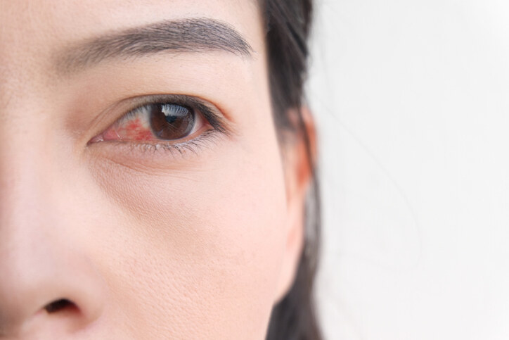 美瞳線副作用5：眼部紅腫