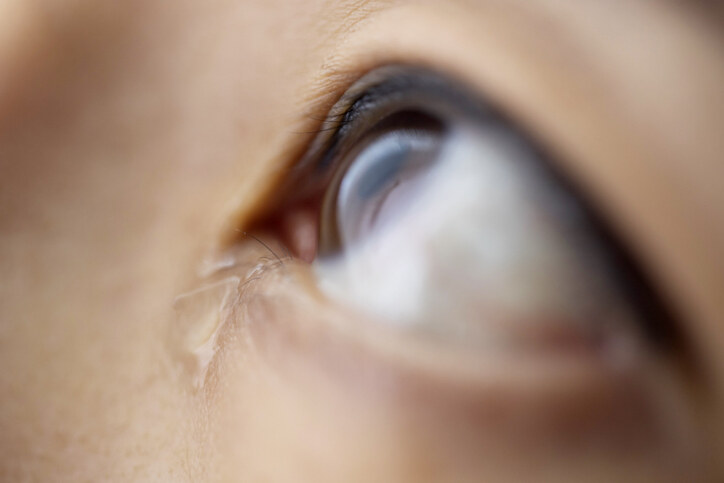 3. 有時候眼腫還伴隨輕微眼痛及流眼水，這是甚麼原因?