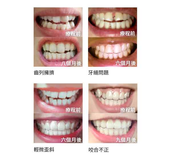 箍牙痛唔痛?網紅及明星推薦Zenyum隱形牙套性價比高,免費專業評估又有香 箍牙痛唔痛?網紅及明星推薦Zenyum隱形牙套性價比高,免費專業評估又有香