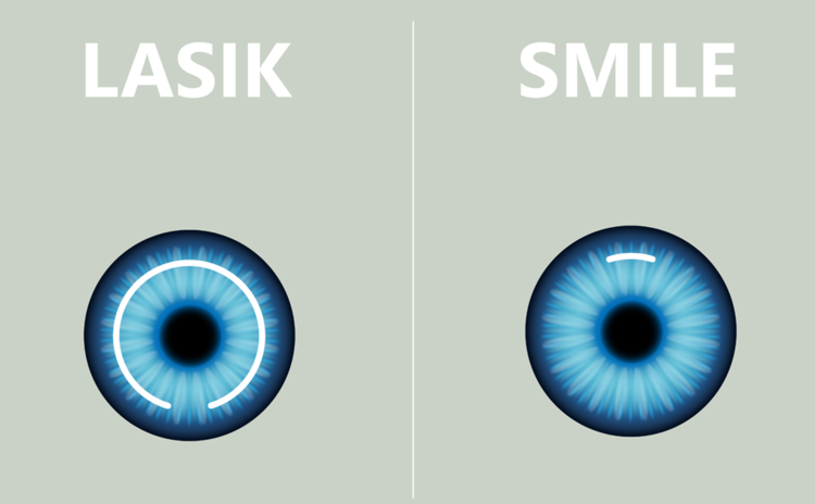SMILE VS LASIK哪種激光矯視適合我？做視力矯正前必知的7件事及考慮條件！