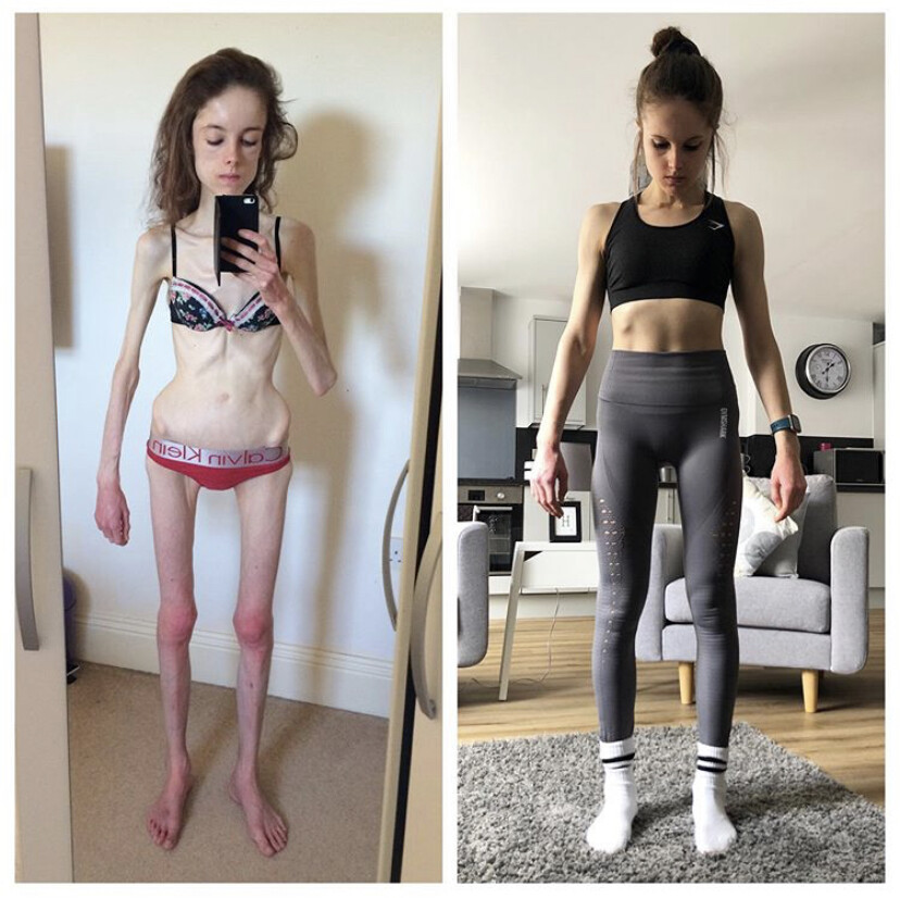 【真人真事】厭食症折磨10年曾誤診為精神病 英女生Hannah:最輕得60磅 【真人真事】厭食症折磨10年曾誤診為精神病 英女生Hannah:最輕得60磅