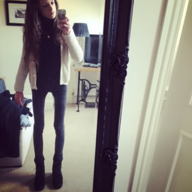 【真人真事】厭食症折磨10年曾誤診為精神病 英女生Hannah:最輕得60磅 【真人真事】厭食症折磨10年曾誤診為精神病 英女生Hannah:最輕得60磅