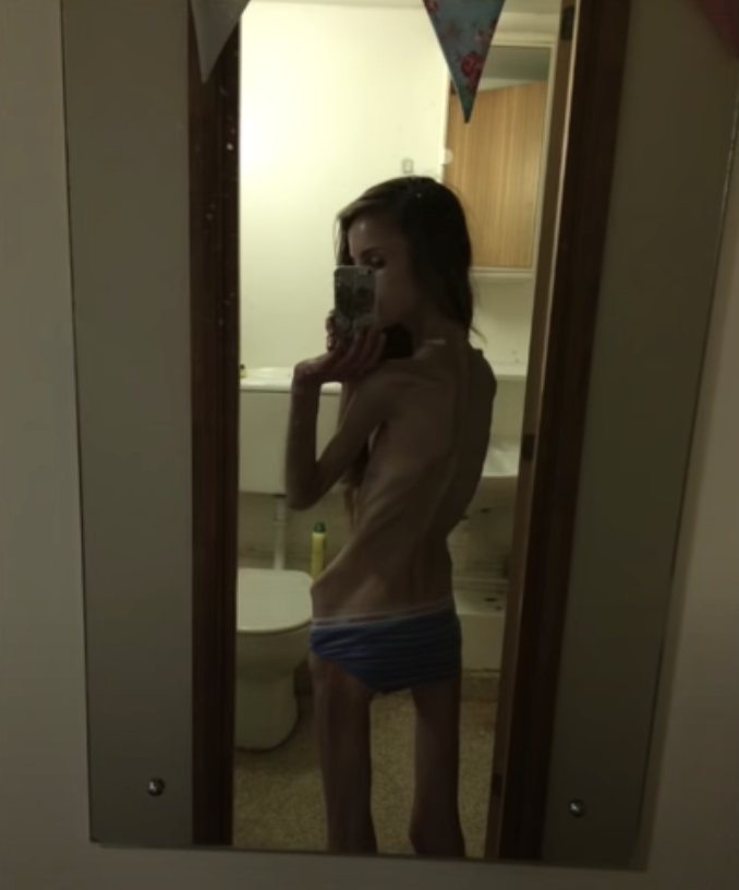 【真人真事】厭食症折磨10年曾誤診為精神病 英女生Hannah:最輕得60磅 【真人真事】厭食症折磨10年曾誤診為精神病 英女生Hannah:最輕得60磅