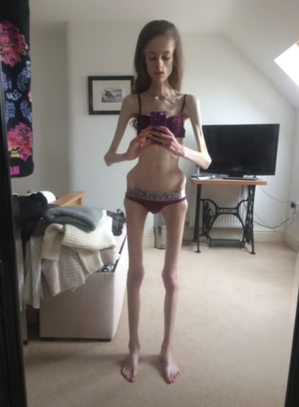 【真人真事】厭食症折磨10年曾誤診為精神病 英女生Hannah:最輕得60磅 【真人真事】厭食症折磨10年曾誤診為精神病 英女生Hannah:最輕得60磅
